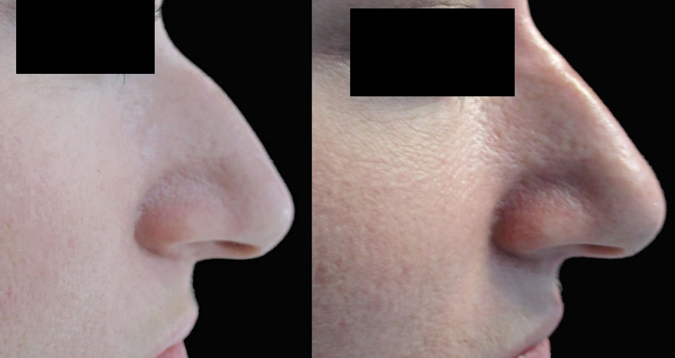 non-surgical-nose_ba